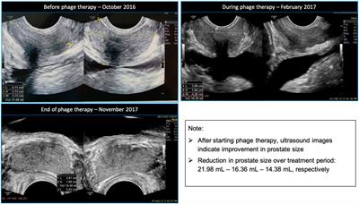 Case Report: Chronic Bacterial Prostatitis Treated With Phage Therapy After Multiple Failed Antibiotic Treatments